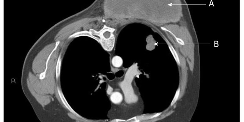 Sarcoma Mets Evaluating Sarcoma Metastasis: The Power of High-Resolution Imaging ...